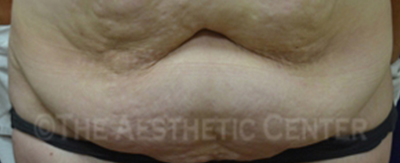abdominoplasty-pat2-cover abdominoplasty-pat2-cover