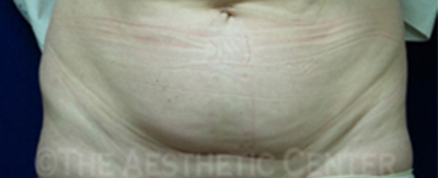 abdominoplasty-pat3-cover abdominoplasty-pat3-cover