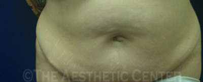 abdominoplasty-pat4-cover abdominoplasty-pat4-cover