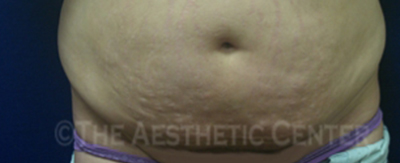 abdominoplasty-pat5-cover abdominoplasty-pat5-cover