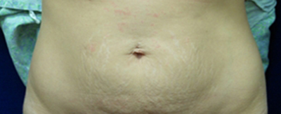 abdominoplasty-pat6-cover abdominoplasty-pat6-cover