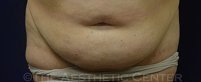 abdominoplasty-pat7-cover