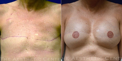 bilateral-implant-reconstruction-cover bilateral-implant-reconstruction-cover