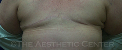 bilateral-implant-reconstruction-pat1-cover
