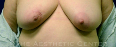 bilateral-implant-reconstruction-pat2-cover