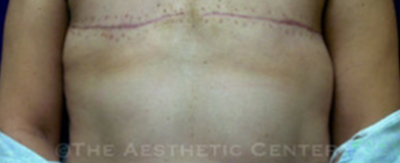 bilateral-implant-reconstruction-pat3-cover