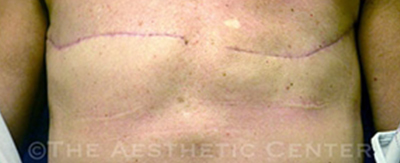 bilateral-implant-reconstruction-pat4-cover
