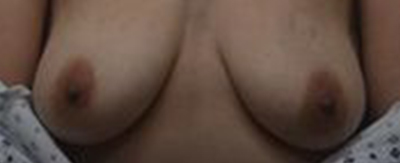 bilateral-implant-reconstruction-pat5-cover