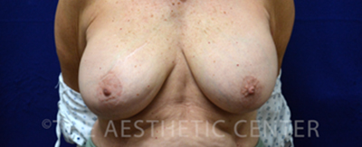 bilateral-implant-reconstruction-pat6-cover