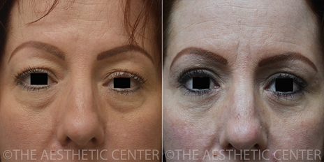 blepharoplasty-lower-cover