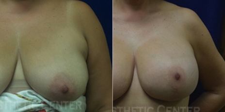 breast-augmentation-cover breast-augmentation-cover