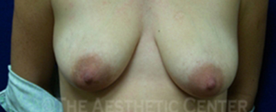 breast-augmentation-periareolar-lift-patient-2-cover