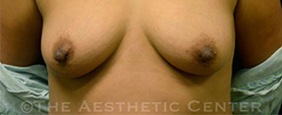 breast-augmentation-periareolar-lift-patient-5-cover
