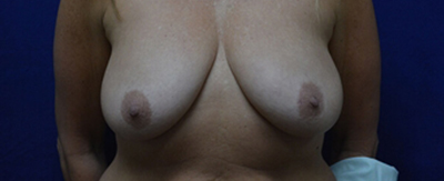 breast-augmentation-periareolar-lift-patient-6-cover