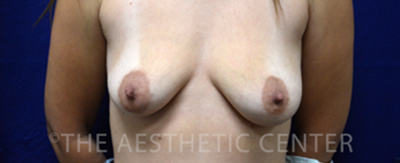 breast-augmentation-periareolar-lift-patient-8-cover