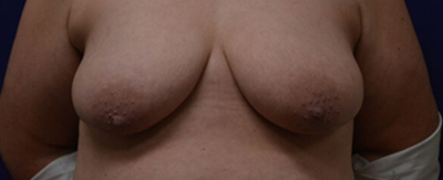 breast-lift-pat3-cover-a