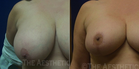 breast-reduction-cover