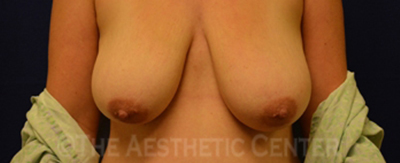 breastlift_anchor_pat02-cover