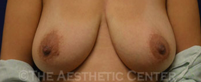 breastlift_anchor_pat03-cover