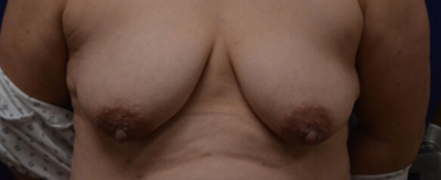 breastlift_anchor_pat04-cover