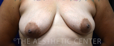 breastlift_anchor_pat05-cover