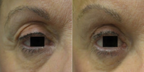 brow-lift-cover
