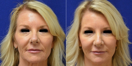 face-lift-cover