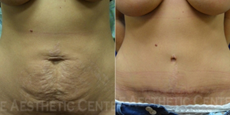 tummy-tuck-cover tummy-tuck-cover