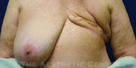 unilateral-implant-reconstruction-cover-b unilateral-implant-reconstruction-cover-b