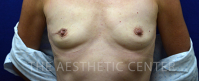 unilateral-implant-reconstruction-pat2-cover unilateral-implant-reconstruction-pat2-cover