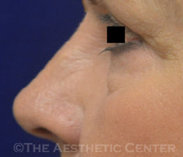 upperblepharoplasty_after01-pat1 upperblepharoplasty_after01-pat1