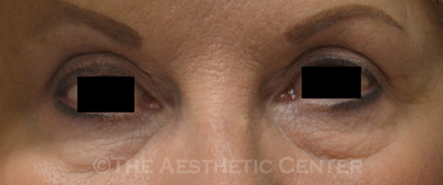 upperblepharoplasty_after01_pat1 upperblepharoplasty_after01_pat1