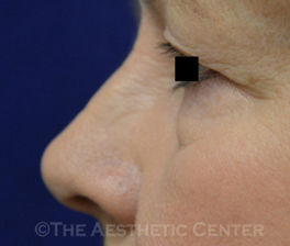 upperblepharoplasty_before01-pat1 upperblepharoplasty_before01-pat1