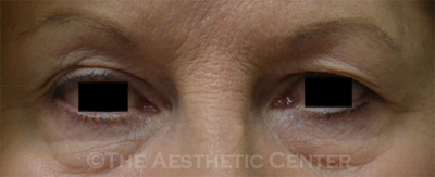 upperblepharoplasty_before_pat1 upperblepharoplasty_before_pat1